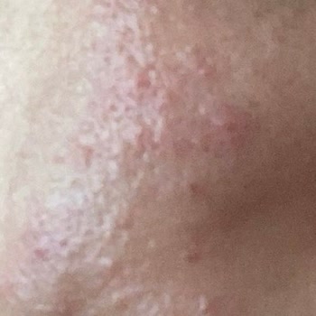 Maruderm Maruz Derm Markası Yüzüme Alerji Yaptı