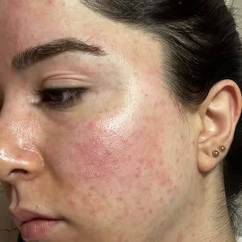 Maruderm Maruz Derm Markası Yüzüme Alerji Yaptı