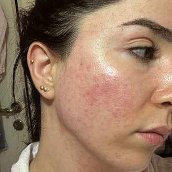 Maruderm Maruz Derm Markası Yüzüme Alerji Yaptı