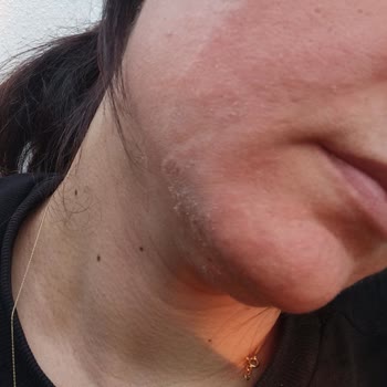 Dermoskin Güneş Kreminin Yüzümde Alerji Yapması.