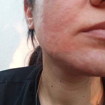 Dermoskin Güneş Kreminin Yüzümde Alerji Yapması.