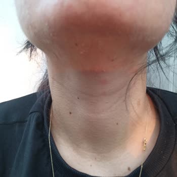 Dermoskin Güneş Kreminin Yüzümde Alerji Yapması.