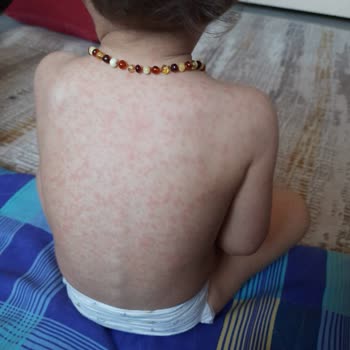 Ecowell Bebek Şampuanı Alerji Yaptı