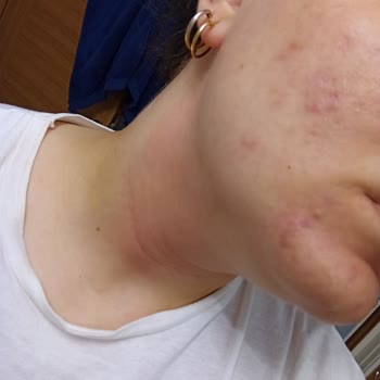 Rossmann Yıkama Jeli ve Peeling Yüzde Yanma Alerji