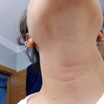 Rossmann Yıkama Jeli ve Peeling Yüzde Yanma Alerji