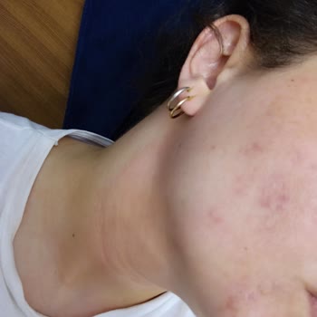 Rossmann Yıkama Jeli ve Peeling Yüzde Yanma Alerji