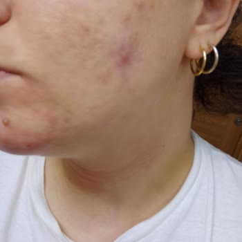 Rossmann Yıkama Jeli ve Peeling Yüzde Yanma Alerji