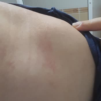 Duru Sabun Alerji Kızarıklık Kaşıntı