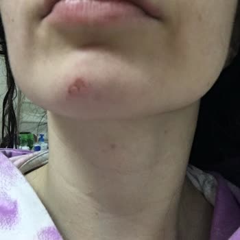 Ayşe Muslu Beauty Center Cilt Bakımı Sırasında Cildimde Kalıcı Hasar Bırakıldı