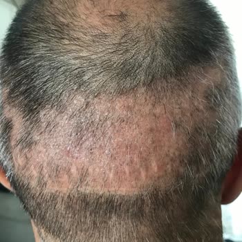 Emphair Saç Ekim Merkezi Saç Ekimi Sonrası Donör Bölgede Dökülme