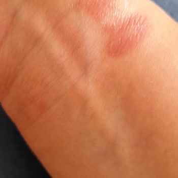 Huawei Akıllı Saatim Bileğimde Yaralar Yaptı