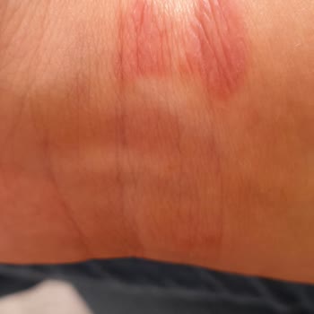 Huawei Akıllı Saatim Bileğimde Yaralar Yaptı