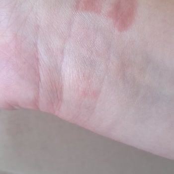 Huawei Akıllı Saatim Bileğimde Yaralar Yaptı