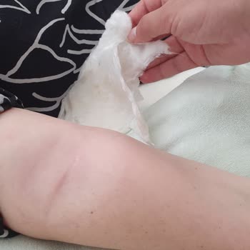 Cumhuriyet Üniversitesi Tıp Fakültesi Hastanesi İlaçlı Tomografi Şişliğe Sebep Oldu