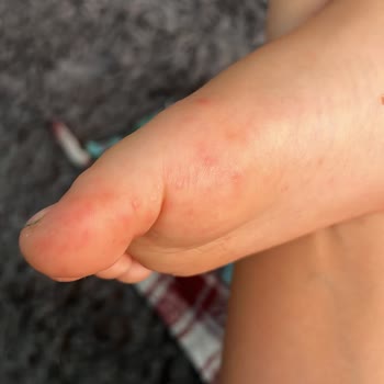 Ladonia Hotels Adakule Havuzdan Mikrop Kaptılar