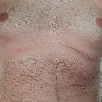 Brenol Vücutta Aşırı Yanma, Kızarıklık Ve Kasıntı Yapıyor