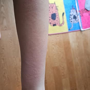 Celenes By Sweden Güneş Ürünleri Cildimde Korkunç Alerjiye Sebep Oldu