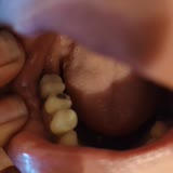 Beyhekim Ağız Ve Diş Sağlığı Merkezi Protez Yaptırırken Yaşadığım Sorunlar