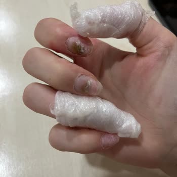 Aymira Koçaklı Yaşam Merkezi Aymira Koçaklı Burda Şubesi Tırnağım Çürüdü