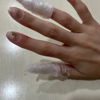 Aymira Koçaklı Yaşam Merkezi Aymira Koçaklı Burda Şubesi Tırnağım Çürüdü