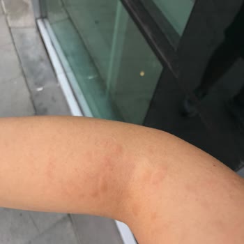 İstinye Üniversitesi Hastanesi Lazer Epilasyon Mağduriyeti