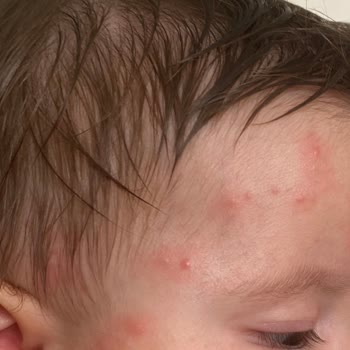 İncia Sprey Bebeğime Alerji Yaptı