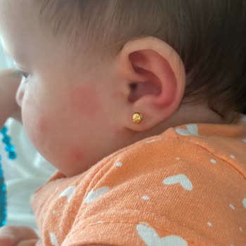 İncia Sprey Bebeğime Alerji Yaptı