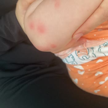 İncia Sprey Bebeğime Alerji Yaptı