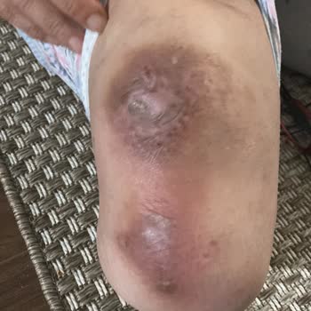 Ottobock Şubesinden Alınan Protez Malzemeleri Sorunu