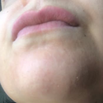 Procsin Güneş Kremi Sivilce Yaptı