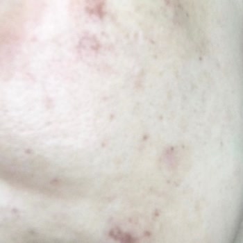 Özel Ladys Kliniği Leke Tedavisiyle Lekelerime Leke Eklendi