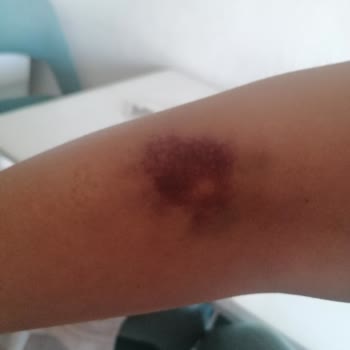 Medicana İzmir Kan Alırken Damarım Patlatıldı.