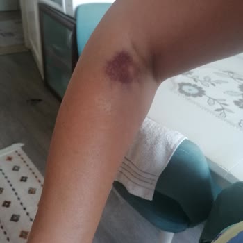 Medicana İzmir Kan Alırken Damarım Patlatıldı.