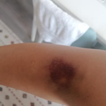 Medicana İzmir Kan Alırken Damarım Patlatıldı.