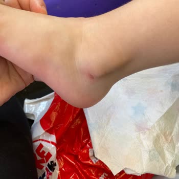 İgor Sandalet Ayakları Yara İçinde Bırakması