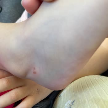 İgor Sandalet Ayakları Yara İçinde Bırakması