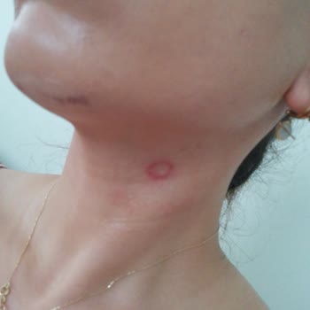 Biblo Güzellik Salonu 2. Derece Yanık Oluştu