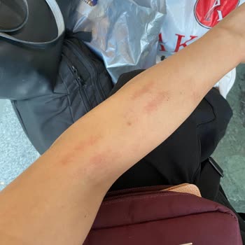 Golden GÜZELLİK (golden Plazadaki) Kollarım Yandı!