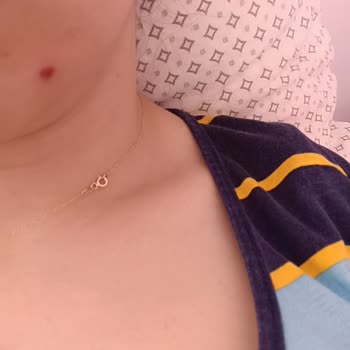 Suit Güzellik Merkezleri Cilt Bakımı Yüzüm Yara Doldu