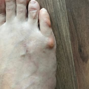 Crocs Terlik Ayakta Yara Ve Kemikte Büyüme Yapıyor