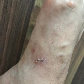 Crocs Terlik Ayakta Yara Ve Kemikte Büyüme Yapıyor