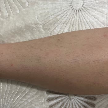 Arya Güzellik Merkezi İzmir Epilasyon Yaptırdık 6 Seans Olacak Dökülmüyor!