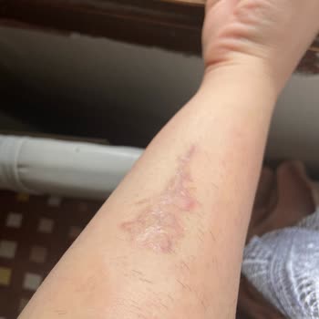 Aris Güzellik Merkezleri Dövme Silme, Cildimi Yaktılar