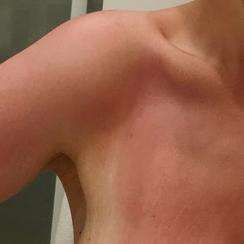 Sebamed Güneş Kremi Yaktı Kül Etti Bizi