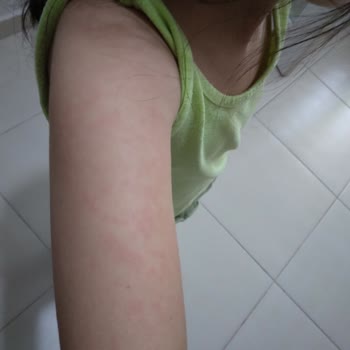 Mustela Avokado Şampuan Alerji