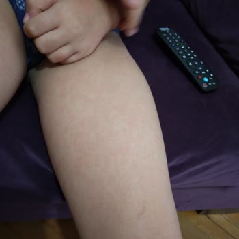 Mustela Avokado Şampuan Alerji