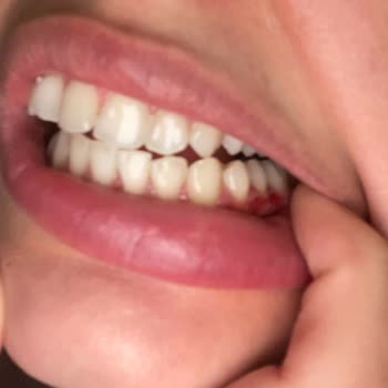 Dent Mec Diş Polikliniği Mavi Işıkla Diş Beyazlatma İşlemi