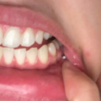 Dent Mec Diş Polikliniği Mavi Işıkla Diş Beyazlatma İşlemi