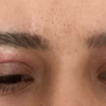 Nama Clinic (Kalamış) Göz Kapağı Plazma Uygulaması