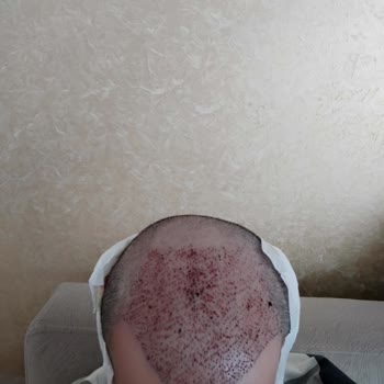 Turkey Hair World Saç Ekimi Mağduriyeti